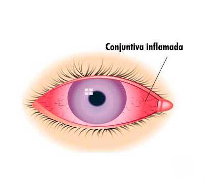 Conjuntiva Inflamada