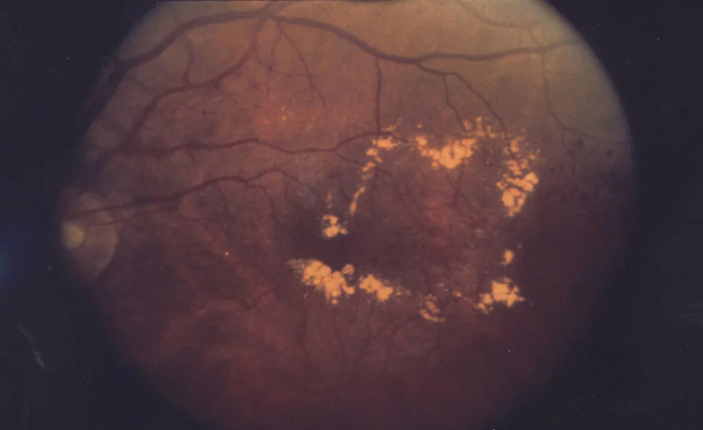 Edema Macular