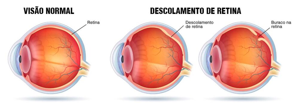 Cirurgia e Tratamento para Descolamento de Retina - COHR