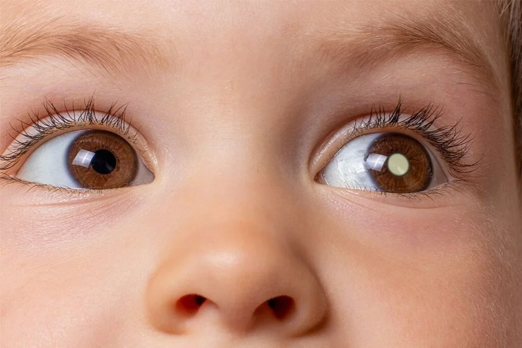 retinoblastoma