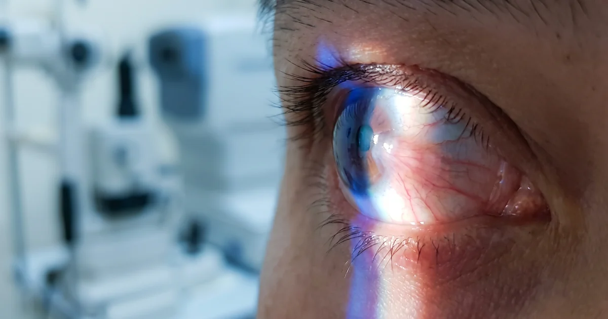 Cirurgia de Pterígio — tratamento da superfície ocular