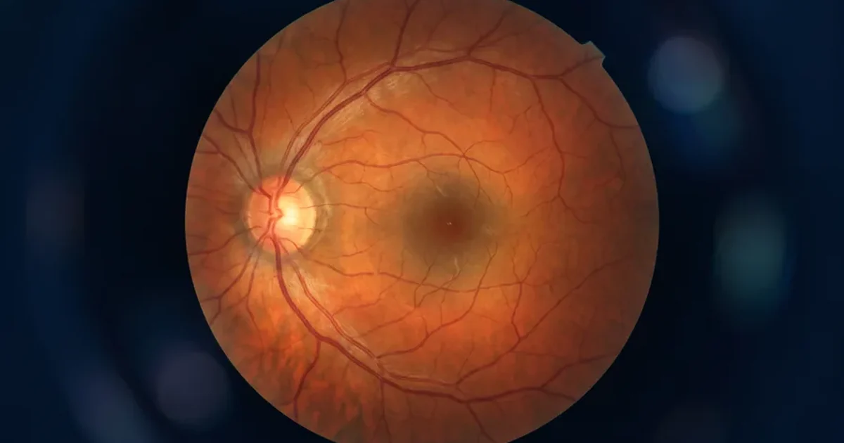 Cirurgia de Retina e Vítreo — ilustração da retina