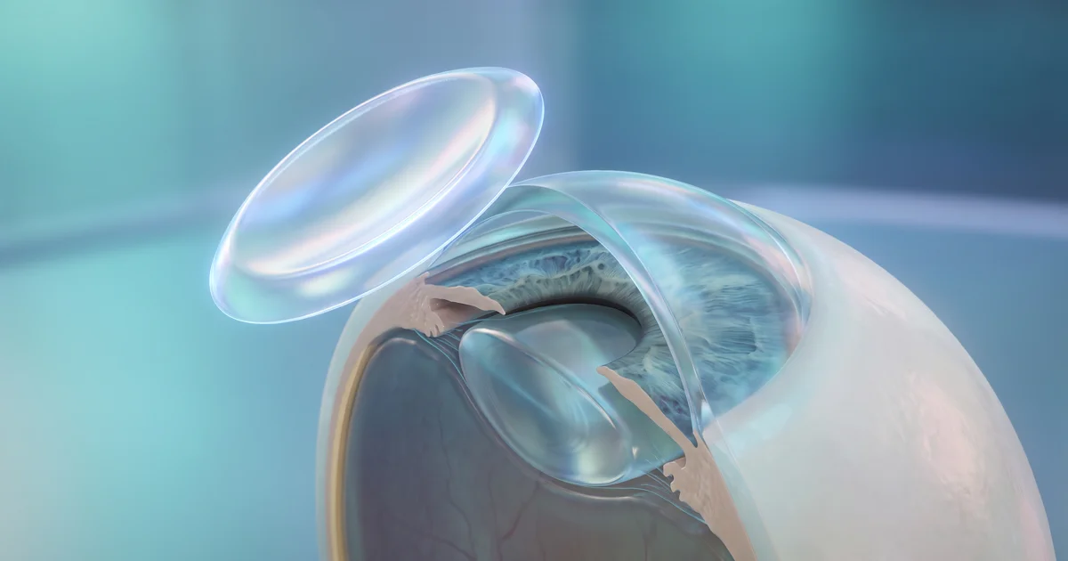Cirurgia de transplante de córnea — ilustração 3D do disco de córnea sendo posicionado no olho em ângulo lateral — Visare Hospital de Olhos Presidente Prudente